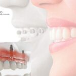 Clínica dental en Pozuelo de Alarcón – Sonrisa saludable y confianza