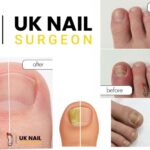 Fungal Nail Surgery: Same-day relief with expert care