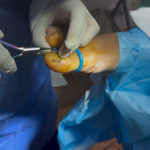 Ingrown Toenail Relief: Fast Same-Day Treatment in the UK