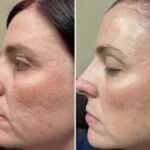 Age Spot Removal in Oakville — Reveal Clearer Skin