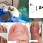 Kids ingrown toenail: gentle care and practical guidance