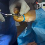 Nail Surgery Birmingham – Quick, Gentle Toenail Care